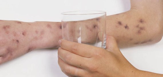 Daugėja besiskiepijančių nuo meningokokinės B tipo infekcijos