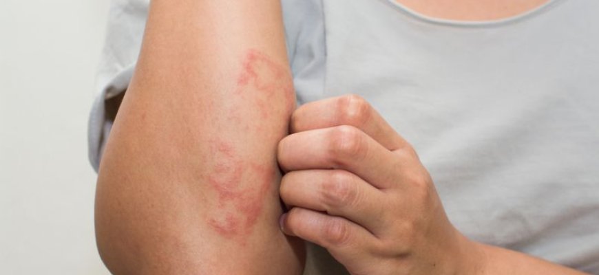 Pavasario įtaka odai: atopinio dermatito pažeista oda atvira infekcijoms