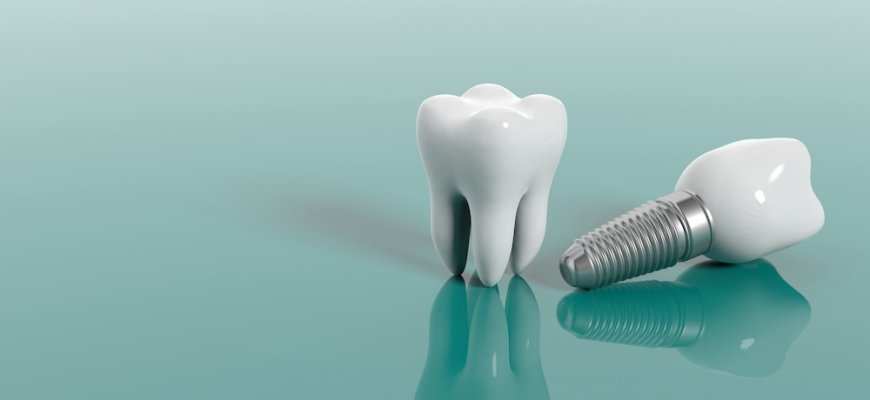 Kam tinka vienmomentė dantų implantacija ir ar ji saugi?
