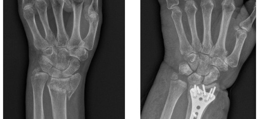 Juodąjį savaitgalį riešo lūžius patyrusiems pacientams gydytojas ortopedas traumatologas turi svarbią žinią